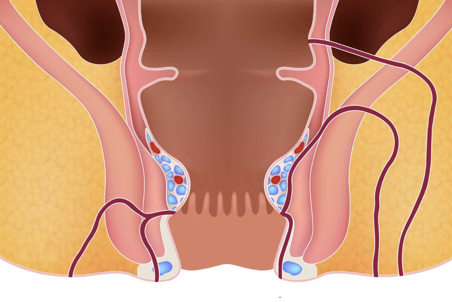 Anal Fistula 