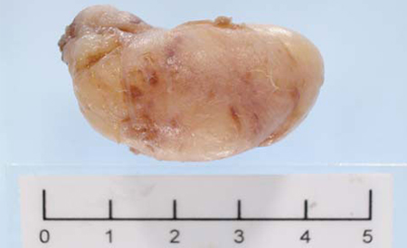 Fibroadenom